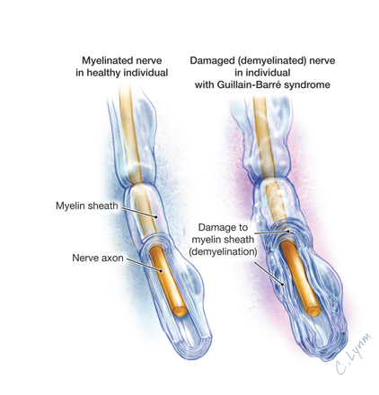 Guillain-Barre Syndrome by Lynm, JAMA 2011