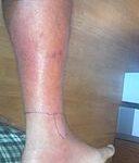 Cellulitis (Courtesy Wikipedia)